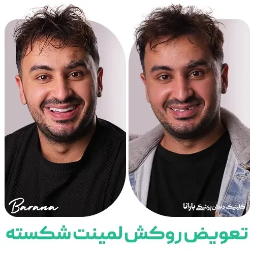 آیا لمینتهای دندان دائمی هستند؟