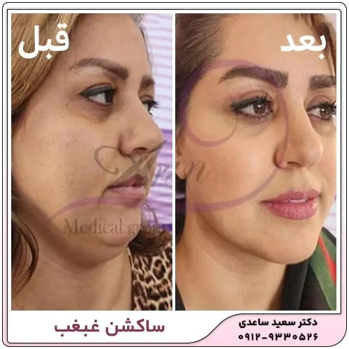 آیا ساکشن غبغب برگشت پذیر است؟